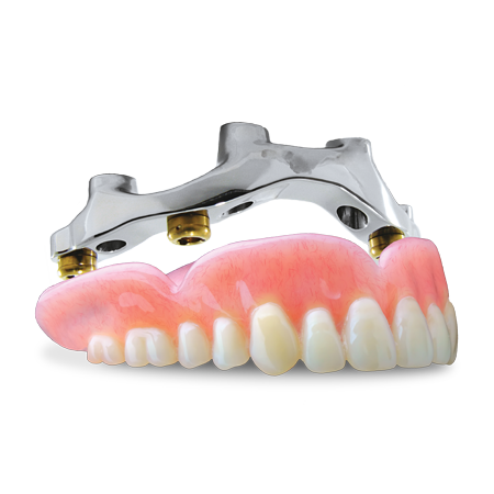 Denture Overbar