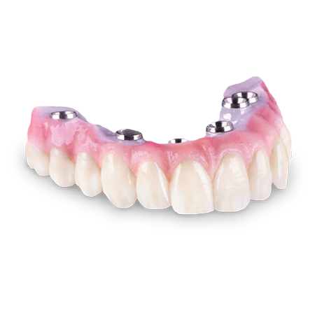 Zirconia Hybrid Implant Bridge